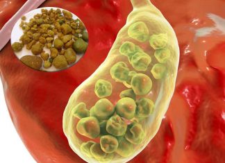 Sticky meshworks of DNA and neutrophils drive gallstone formation