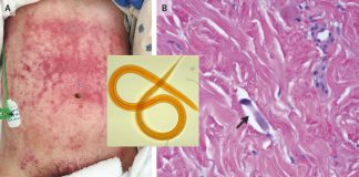 A human infective nematode found in canine carriers for the first time