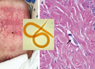 A human infective nematode found in canine carriers for the first time
