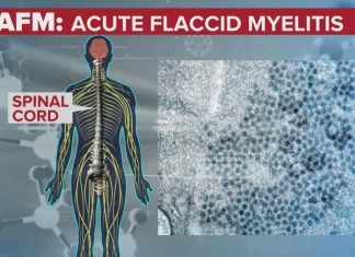 Acute flaccid myelitis patients : researchers found direct evidence of enterovirus infection in the cerebrospinal fluid (CSF)