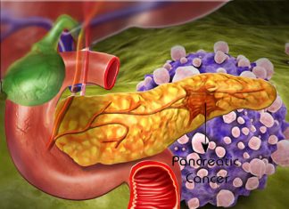 Researchers has revealed how aggressive pancreatic cancer cells change their environment to spread