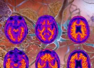 Alzheimer’s disease : researchers found that by removing brain immune cells beta-amyloid plaques never formed