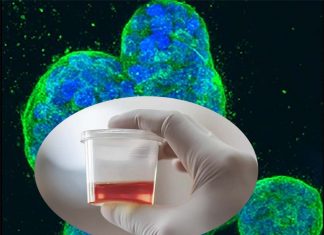 Research evidence that clotting proteins are elevated in the urine of patients who suffer from lupus nephritis (LN)