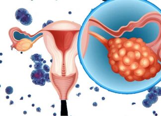 Researchers developed a test that may be able to detect ovarian cancer up to two years earlier