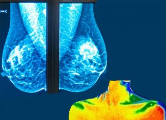 Researchers have investigated the long-term effect of hormonal therapy in women with hormone-sensitive breast cancer