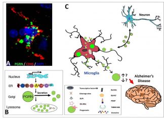 Alzheimer : creation of new brain cells can be disrupted by the brain’s own immune cells