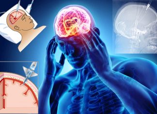 Researchers has devised a much less invasive way to monitor intracranial pressure (ICP)