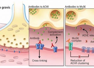 Researchers have identified a unique biological marker to identify the rare autoimmune disease myasthenia gravis