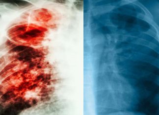 Australian medical researchers have successfully developed a new type of vaccine targeting tuberculosis