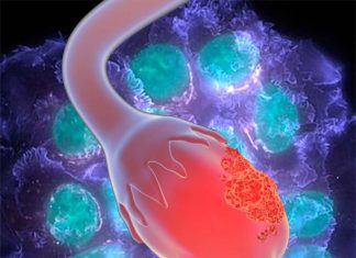 New treatment for inherited breast and ovarian cancer