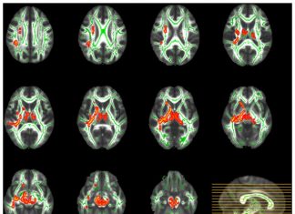 Excessive interaction with e-devices may be related to weaker activity in the brain