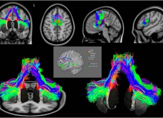 Primary progressive aphasia (PPA) : Scientists identified three regions in the brain that fail to talk to each another