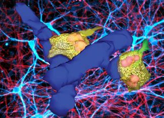 High-grade gliomas form synapses which hijack electrical signals from healthy neurons in the brain – promoting tumor growth