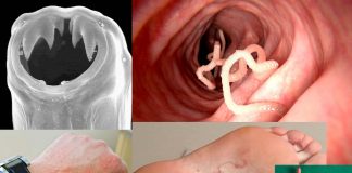 Human hookworm infection can cause rapid acute cognitive impairments