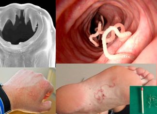 Human hookworm infection can cause rapid acute cognitive impairments