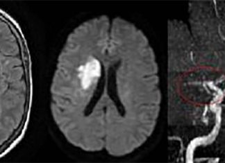 The importance of MRI in helping to diagnose minor stroke and TIAs