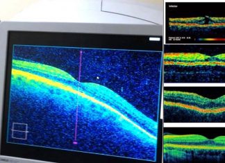 Alzheimer : Identified important biomarkers in retinal layer