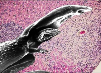 Schistosomiasis: a parasitic disease that affects more than 200 million people worldwide