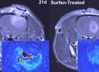 Surfen could block tumor growth for patients with glioblastoma brain cancer