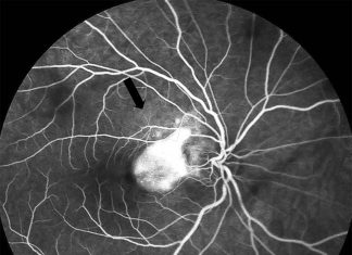 Toxoplasma parasite causes a distinctive lesion in the retina