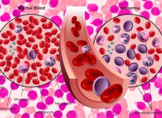 A novel CAR T-cell therapy has shown very promising results for children with previously incurable acute lymphoblastic leukemia (ALL)