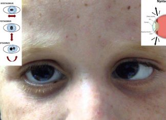 Researchers found the cause of congenital nystagmus