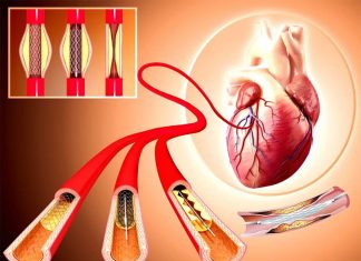 Patients with heart artery stenting can reduce risk of future heart attacks with additional heart artery stenting in other untreated arteries