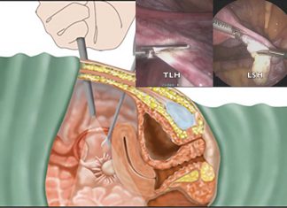 Modified hysterectomy technique using keyhole surgery it’s safer and more effective than current techniques