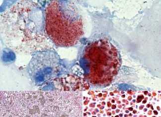 Researchers identified new vaping-related respiratory illness – large immune cells containing numerous oily droplets