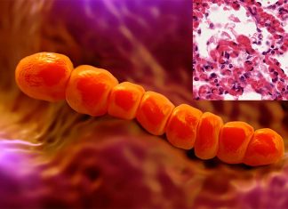 Pneumonia : Bacteria use hydrogen peroxide to weaken the immune system