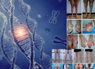 Charcot-Marie-Tooth disease : researchers founds link with the aminoacyl-tRNA synthetases enzyme