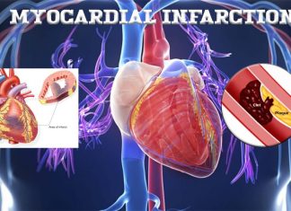 Myocardial infarction remains a leading cause of mortality and morbidity worldwide