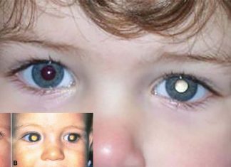 White eye it’s a sign of pathology