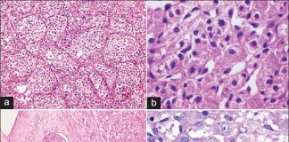 An experimental targeted drug could treat a rare type of cancer usually affecting the limbs