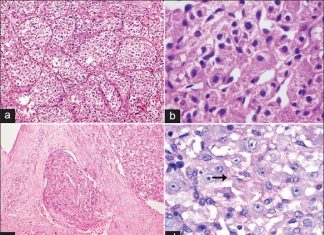 An experimental targeted drug could treat a rare type of cancer usually affecting the limbs