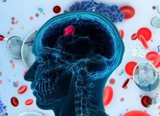 A blood test can predict how patients will progress after they are diagnosed with glioblastoma (GBM)