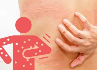 People with chronic itching conditions are at increased risk of stress – depression and suicidal