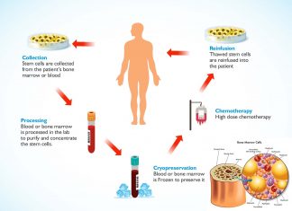 Researchers found rapid method to obtain donor stem cells for bone marrow transplants using a combination of Viagra and Plerixafor