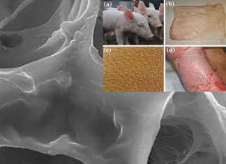 Burn specialists successfully used live-cell – genetically engineered pig skin (xenograft) – for the temporary closure of a burn wound