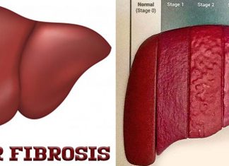 Rilpivirine, an antiretroviral drug used for treating HIV, has beneficial effects on chronic liver diseases