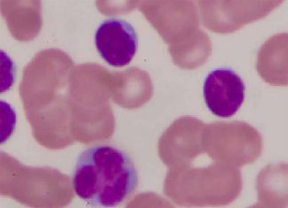 Parkinson’s disease involves monocytic alterations in the blood