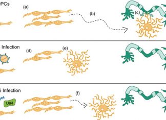 Researchers link the Human Herpes Virus 6A to the development of multiple sclerosis