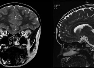 Researchers have identified two molecules that might be linked to Kallmann syndrome