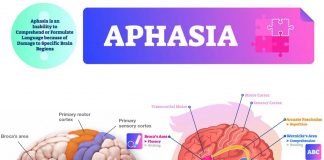 One of the main causes of aphasia is stroke