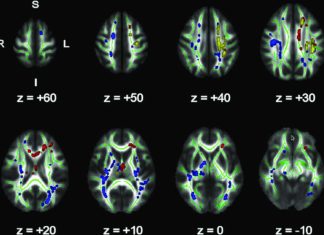 Fractional anisotropy values are reduced in the corpus callosum and middle orbital gyrus in obese teens