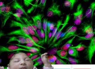 How can Zika virus infection in the uterus lead to microcephaly in newborns?
