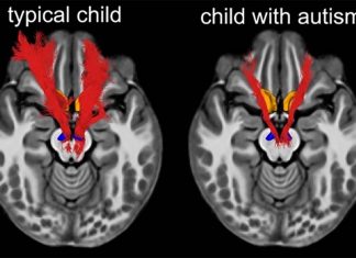People with autism have left and right brain areas more symmetrical