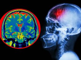 Researchers found how brain injury can lead to post-traumatic stress disorder