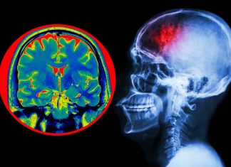 Researchers found how brain injury can lead to post-traumatic stress disorder