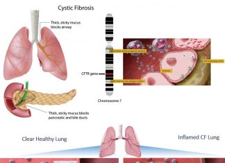 Elexacaftor-tezacaftor-ivacaftor combined therapy improve lung function and reduced symptoms in cystic fibrosis (CF) patients